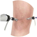 Knee Arthoscopy