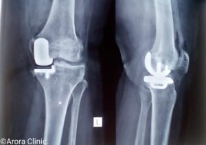 Partial Knee Replacement Xray