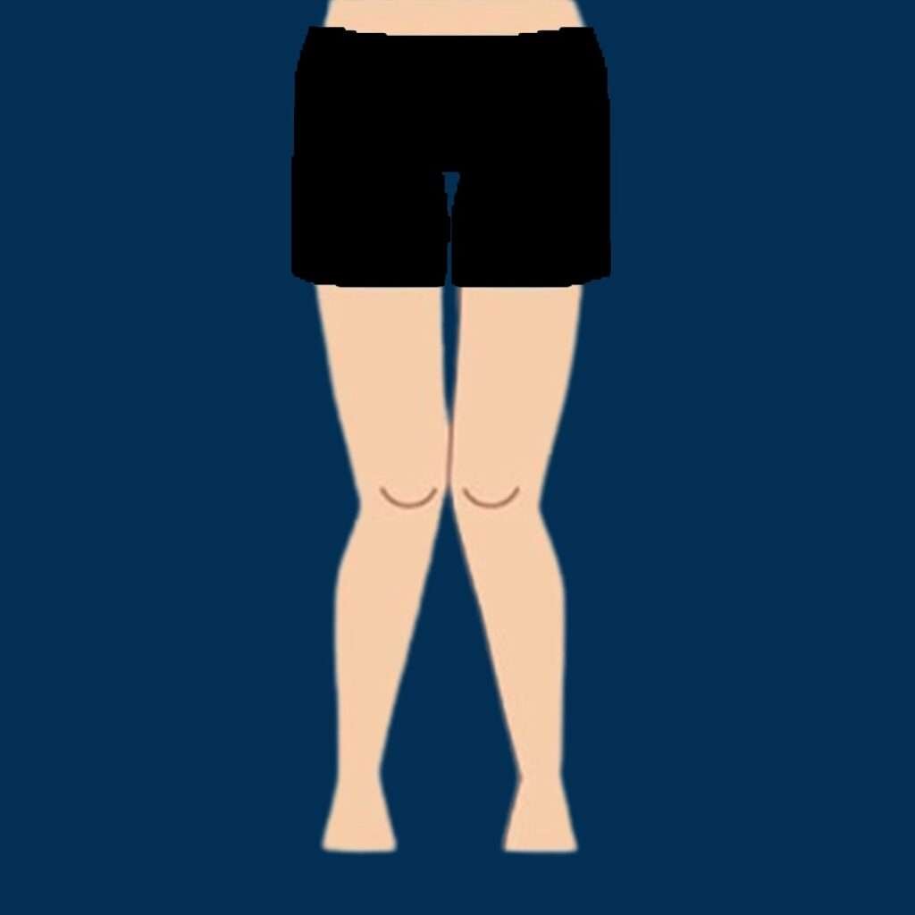 Knock Knee Causes, Symptoms, Diagnosis and Treatment