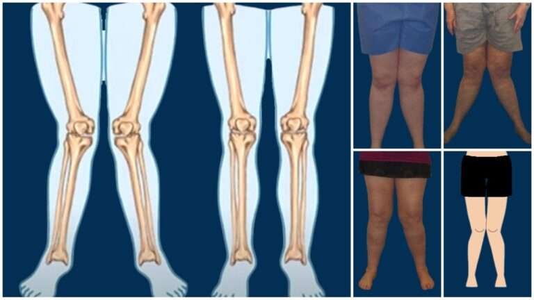 Knock Knee: Causes, Symptoms, Diagnosis and Treatment