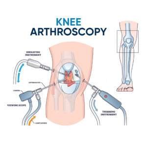 Knee Arhroscopy Surgery