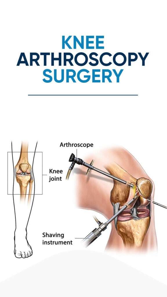 Best Knee Arthroscopy Surgery in Thane Arora Clinic