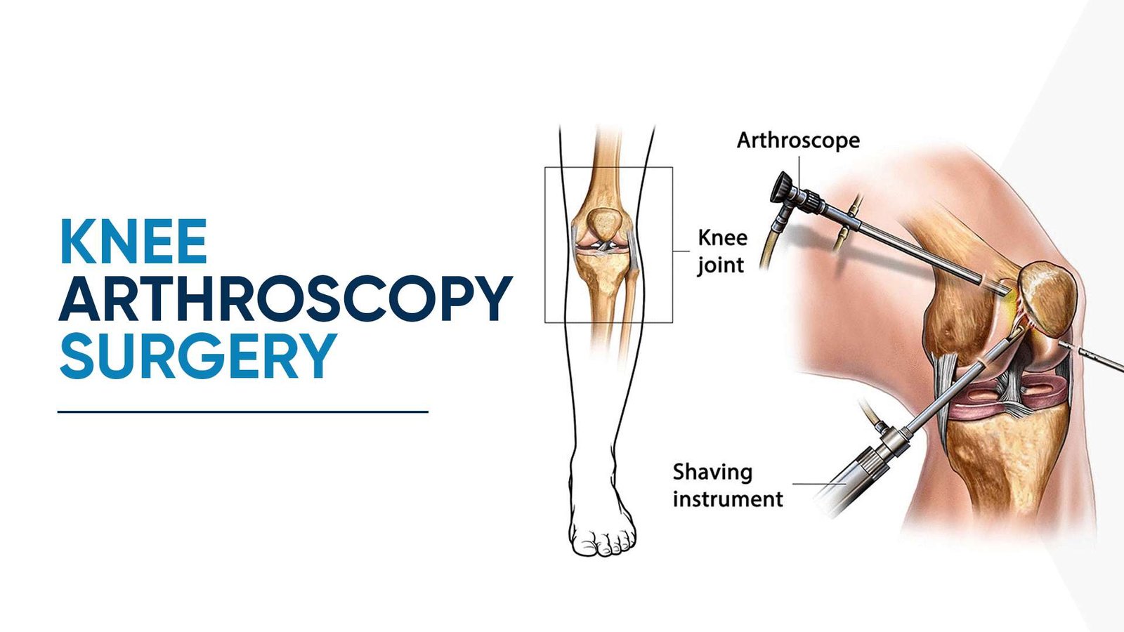 Knee Arthroscopy Surgery in Thane