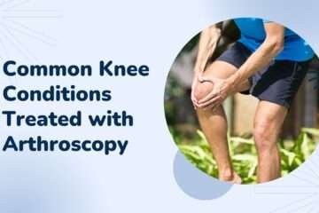 Common Knee Conditions Treated with Arthroscopy