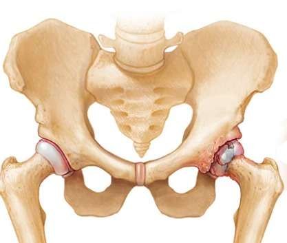 Robotic hip replacement