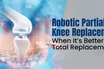 Robotic Partial Knee Replacement When It’s Better Than Total Replacement